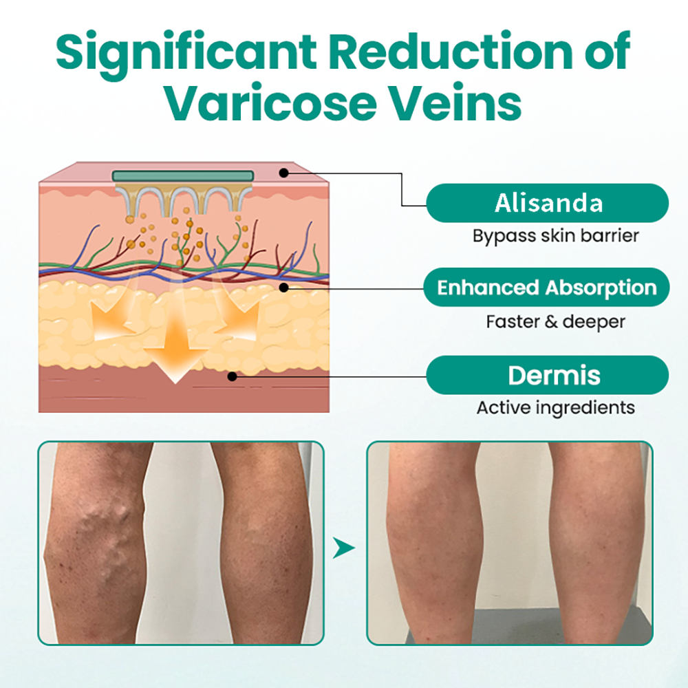 Alisanda® Varicose Veins Patch