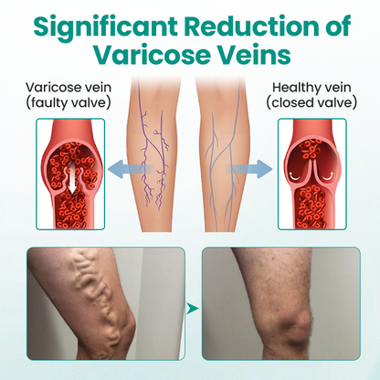 Alisanda® Varicose Veins Patch