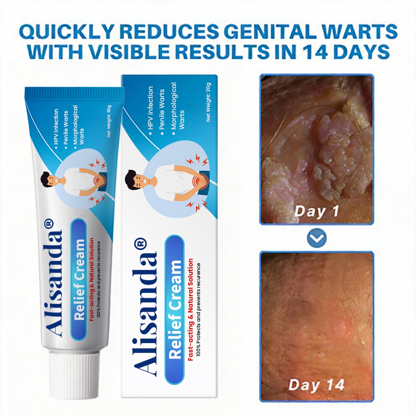 Alisanda® HPV Genital Warts Relief Cream