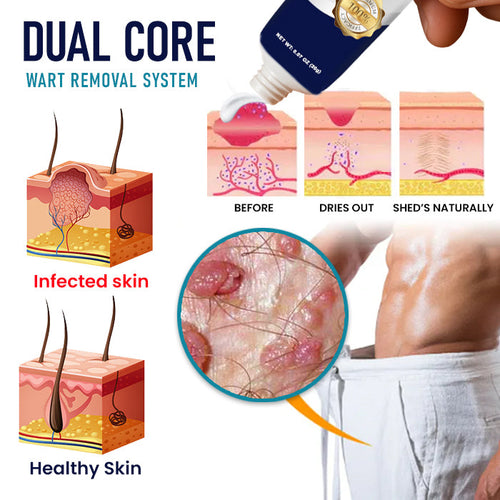 Alisanda® Genital Warts Remover Cream 👨Designed for Men